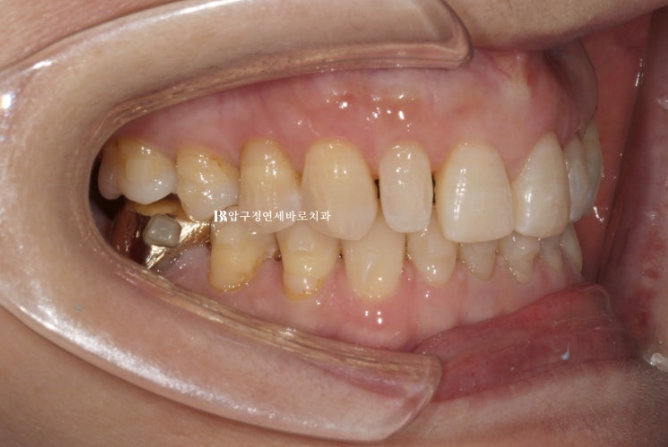 Can It Be Done in Your 50s? Real Results from Limited Front Teeth Orthodontics + No-Prep Laminate Veneers Revealed image 11