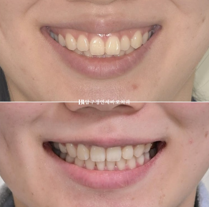 Gummy Smile Correction, Gummy Smile Orthodontics, Rabbit Teeth Correction image 18