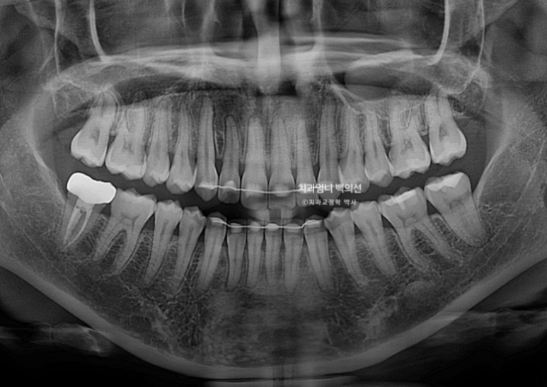인비절라인 비발치 덧니 교정 반대교합 치료 후기 관련 이미지 22