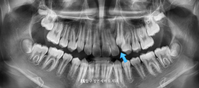 덧니 인비절라인 교정 :: 강남 인비절라인 교정치과 관련 이미지 2