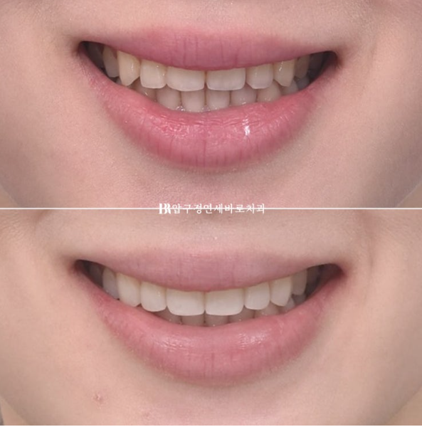 Before and After Non-Prep Veneers: Improving Gaps Between the Front Teeth and the Smile Line Together image 12