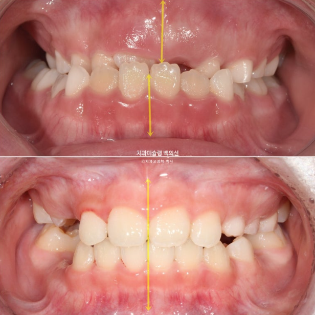 어린이 비대칭 반대교합 주걱턱 인비절라인 퍼스트 프리올소 성장 교정 관련 이미지 25
