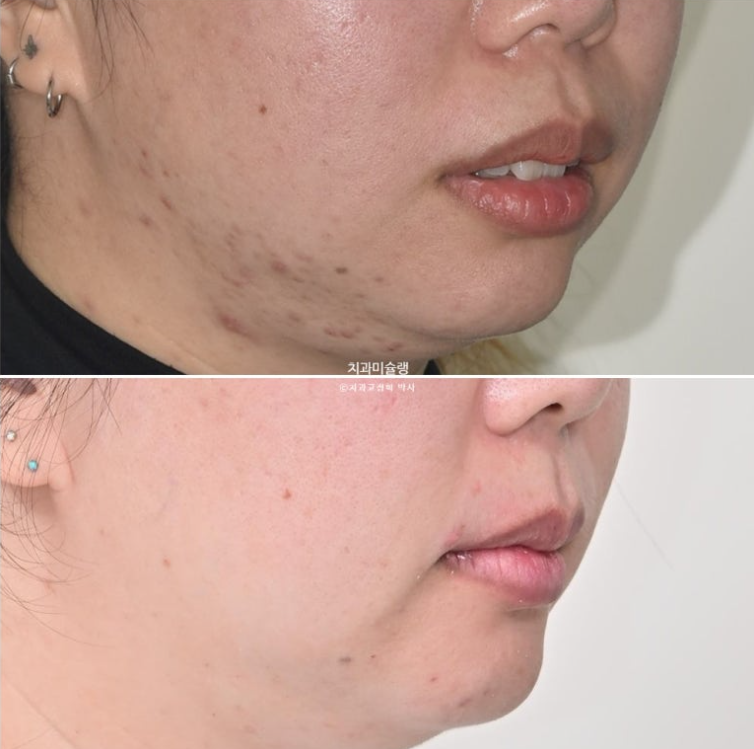 Extraction Orthodontics with Clippy-C for Protruding Mouth, Gum Smile, Gummy Smile Correction, and Treatment for a Recessed Chin image 18