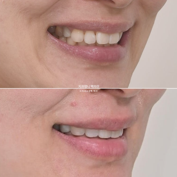 50대 캔팅 교합평면 기울어짐 덧니 교정 인비절라인 라이트 교정? 관련 이미지 15