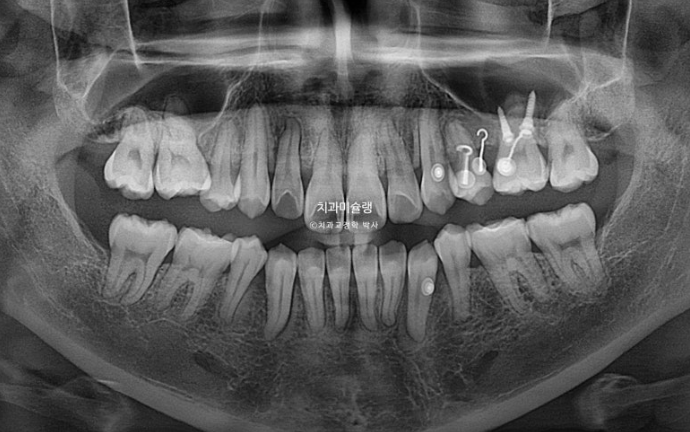 30대 인비절라인 덧니 발치교정 개방교합 치료 관련 이미지 13
