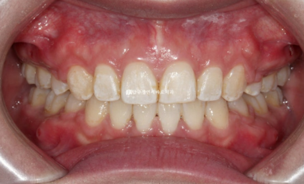 돌출입 교정 입동굴 클리피씨 교정 후기 관련 이미지 9