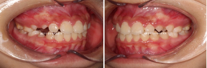 A Child’s Protruding Teeth Correction Review: Difficulty Closing the Lips image 7