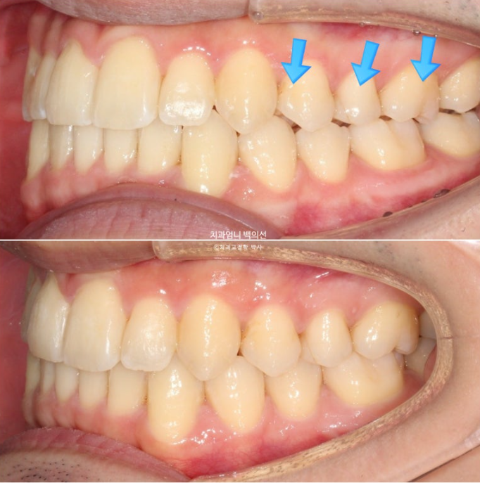인비절라인 비발치 앞니 돌출 덧니 교정 ? 관련 이미지 13