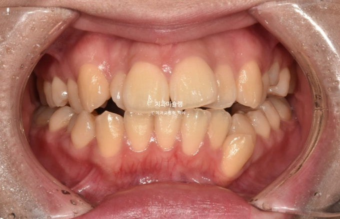 30대 인비절라인 덧니 발치교정 개방교합 치료 관련 이미지 2