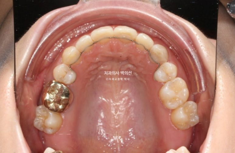 인비절라인 라이트 재교정 발치공간 벌어짐 ? 관련 이미지 8