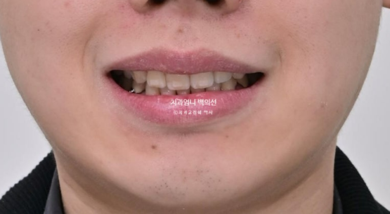 돌출입 발치 교정 인비절라인 후기 미니스크류 관련 이미지 14