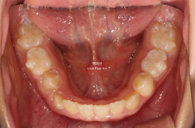 인비절라인퍼스트 어린이 투명교정 과개교합 덧니 악궁확장 돌출 관련 이미지 14