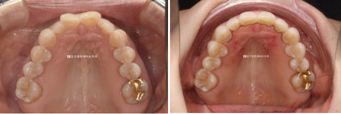 50s Invisalign Lite No-Prep Laminate Bunny Teeth image 18