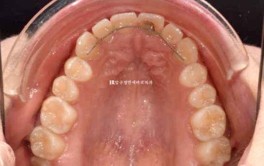 Non-Prep Veneer Review | A Case Naturally Improving Gaps Between the Front Teeth and the Smile Line image 6