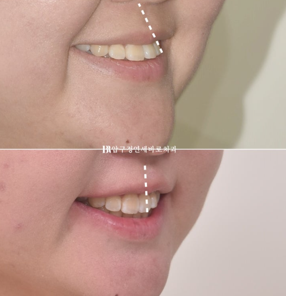 서울 인비절라인 치과 재교정 뻐드렁니 교정 관련 이미지 9