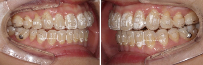 양악수술 선수술 교정 후기 인비절라인 교정 관련 이미지 9