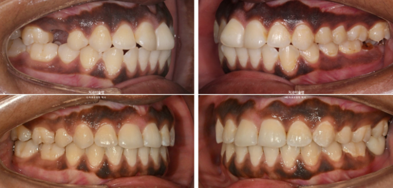 Extraction & re-orthodontics with Clippy-C, intrusion for dental implant. 관련 이미지 20