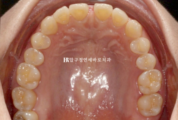 Can Gaps Between the Front Teeth Be Treated with No-Prep Veneers Alone? A Real Case Completed with Gelami After Invisalign Lite image 5