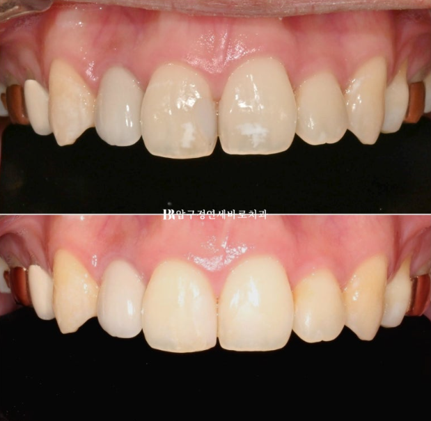 Icon White Spots on Teeth: Resin Treatment for White Spot Lesions image 1
