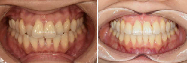 Gangnam Orthodontic Clinic: A Woman in Her 30s’ Rabbit Teeth Correction Review|Six-Month Front Teeth Partial Orthodontic Treatment That Also Improved a Crossbite image 6
