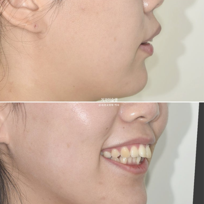 돌출입 덧니 발치 교정 인비절라인 교정 후기 관련 이미지 7