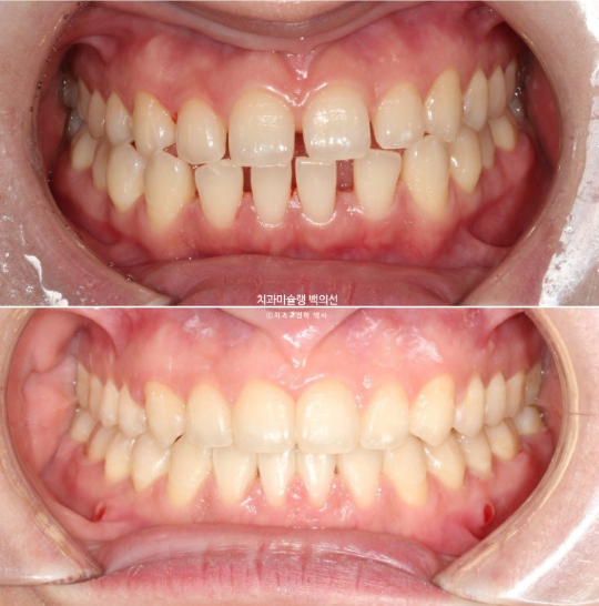 앞니 벌어짐 합죽이 방지 교정 기간 1년 4개월 관련 이미지 13