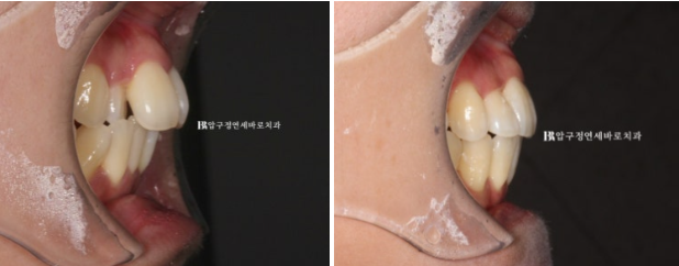 결혼식 6개월 전, 교정 시작해도 될까요? 관련 이미지 12