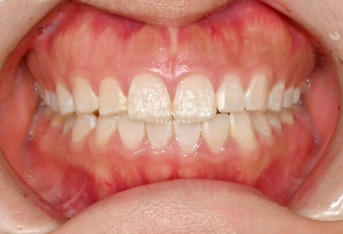 반점치 반상치 치아 하얀 얼룩 치료하기 관련 이미지 2