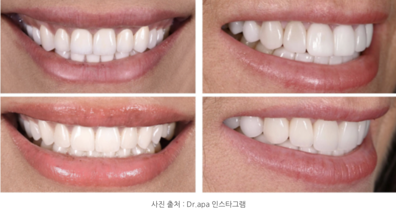 라미네이트 하고 후회하는 경우와 만족하는 경우의 차이 관련 이미지 8