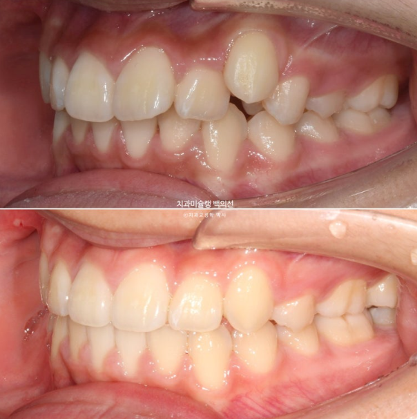 덧니 돌출입 발치교정 상악만 2개 편악 발치 클리피씨 입술부전증 치료 관련 이미지 15