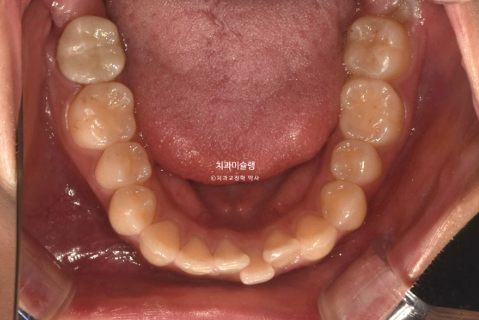 유학생 치아교정 해외거주 한국에서 치아교정? 관련 이미지 6