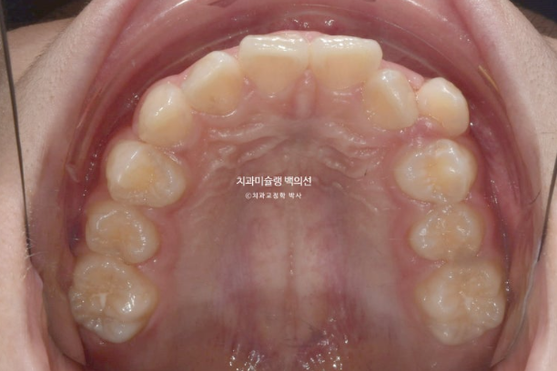 덧니 돌출입 발치교정 상악만 2개 편악 발치 클리피씨 입술부전증 치료 관련 이미지 5
