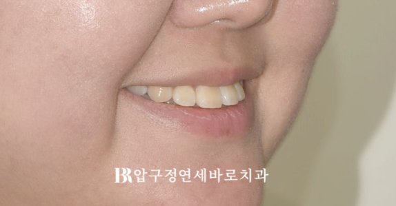 서울 인비절라인 치과 재교정 뻐드렁니 교정 관련 이미지 3