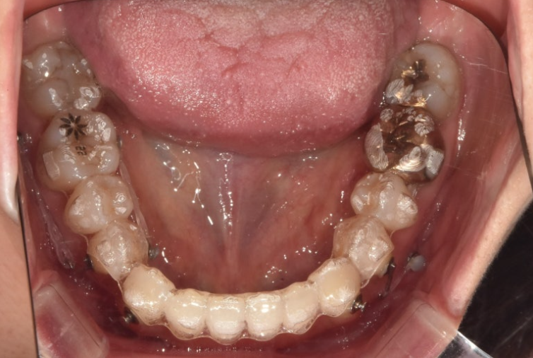30대 비수술 비발치 주걱턱 부정교합 인비절라인 교정 관련 이미지 8