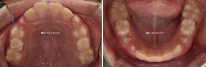 Pediatric Clear Aligners That Improved Both Deep Bite and Protruding Teeth image 5