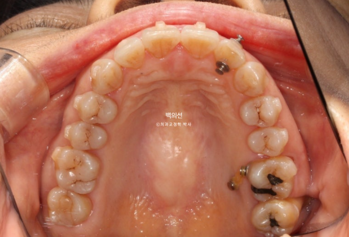 40대 인비절라인 라이트 앞니 돌출 과개교합 덧니 교정 후기 관련 이미지 10