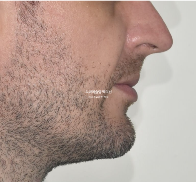 앞니 선천적 결손 인비절라인 임플란트 과개교합 치료 기간 관련 이미지 4