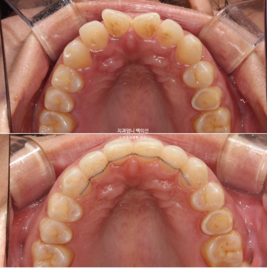 40대 인비절라인 라이트 앞니 벌어짐 뻗침 돌출 치료 관련 이미지 17