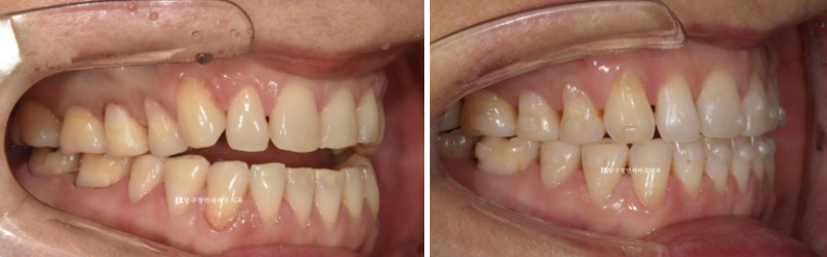 50대 인비절라인 개방교합 합입교정 미니스크류 관련 이미지 8