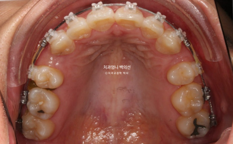 30대 교정 돌출입 교정 덧니 발치교정 치료기간 1년 8개월 관련 이미지 7