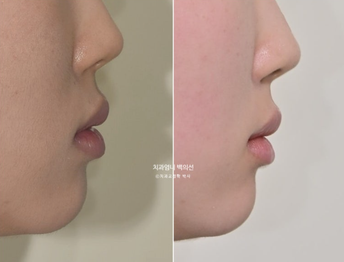 인비절라인 교정 비발치 비대칭 덧니 중심선 선천적 결손치 교정? 관련 이미지 21