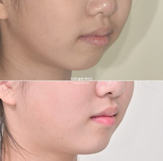 돌출입 무턱 인비절라인 발치교정 덧니 치료기간 1년 11개월 관련 이미지 15