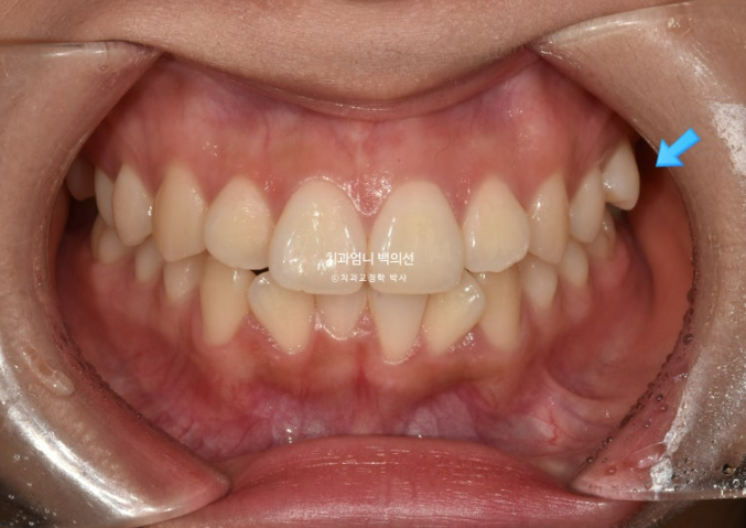 앞니 부분 교정 토끼이빨 덧니교정 ? 관련 이미지 2