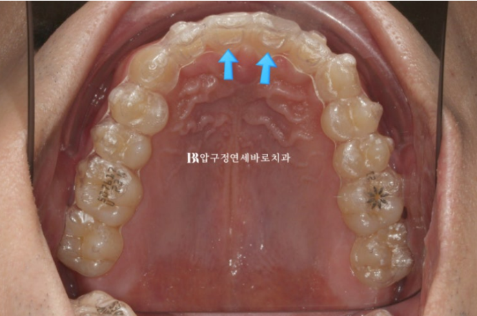 Can Invisalign Fix a Gap Between the Front Teeth? ๐ฎ A Real 9-Month Case Finished Without Remaking Aligners image 4