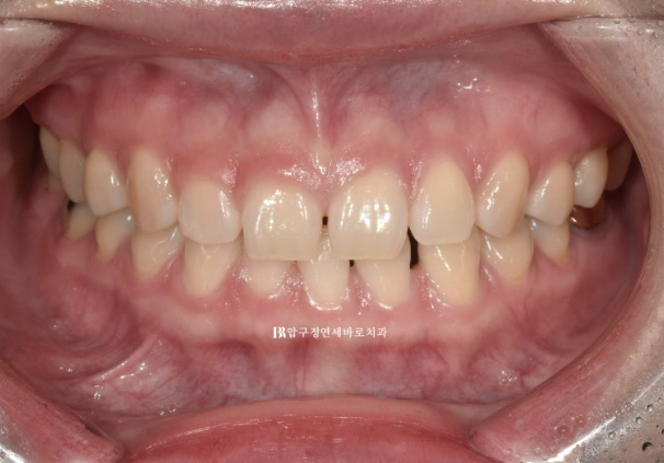 If Your Front Teeth Look Spaced Due to Peg-Shaped Teeth or Microdontia: A Case Choosing No-Prep Veneers Instead of Orthodontic Treatment image 1