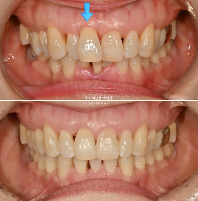 50대 치아교정 중년 발치교정 블랙트라이앵글 치료 후기 관련 이미지 16