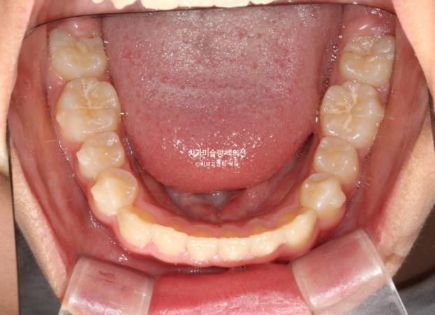 덧니 반대교합 과개교합 인비절라인 퍼스트 악궁확장 어린이 교정 관련 이미지 15