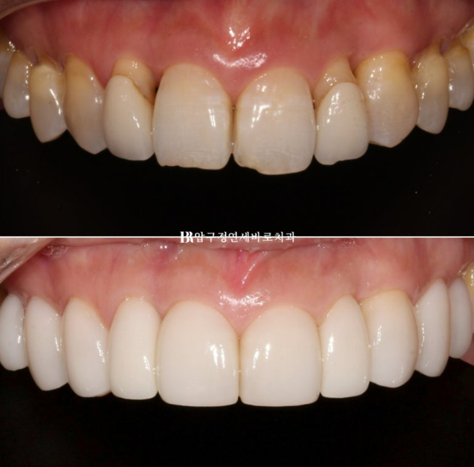 40대 오래된 크라운 교체 / 블랙트라이앵글 젤라미 치료 결과 관련 이미지 6