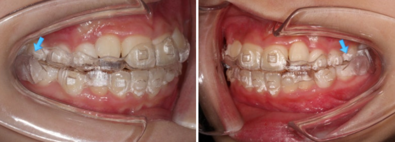 어린이 무턱 성장교정 덧니 인비절라인 퍼스트 악궁확장 치료기간 2년 관련 이미지 17