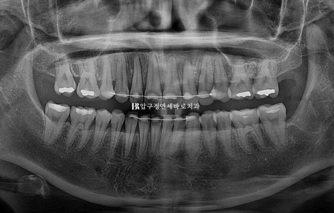 인비절라인 돌출입 발치교정 거미스마일 잇몸미소 교정 관련 이미지 17